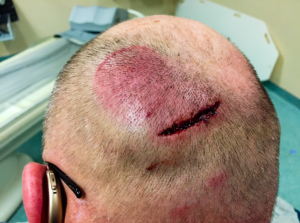 A photo taken at Barnes-Jewish Hospital with Adam Clark’s cellphone shows his head wound before it was closed with eight staples. 